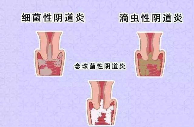 霉菌性陰道炎的表現(xiàn)有哪些？日常需要怎樣護(hù)理？[圖]