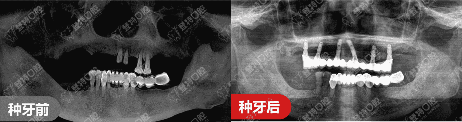 顛覆傳統(tǒng)種牙，佛山登特口腔一日得技術(shù)，一天搞定種牙全過程