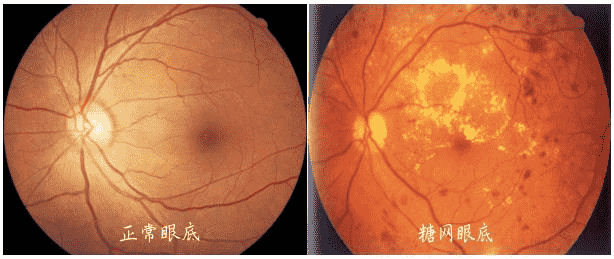 合肥愛爾眼科醫(yī)院：糖尿病患者，注意定期檢查眼底