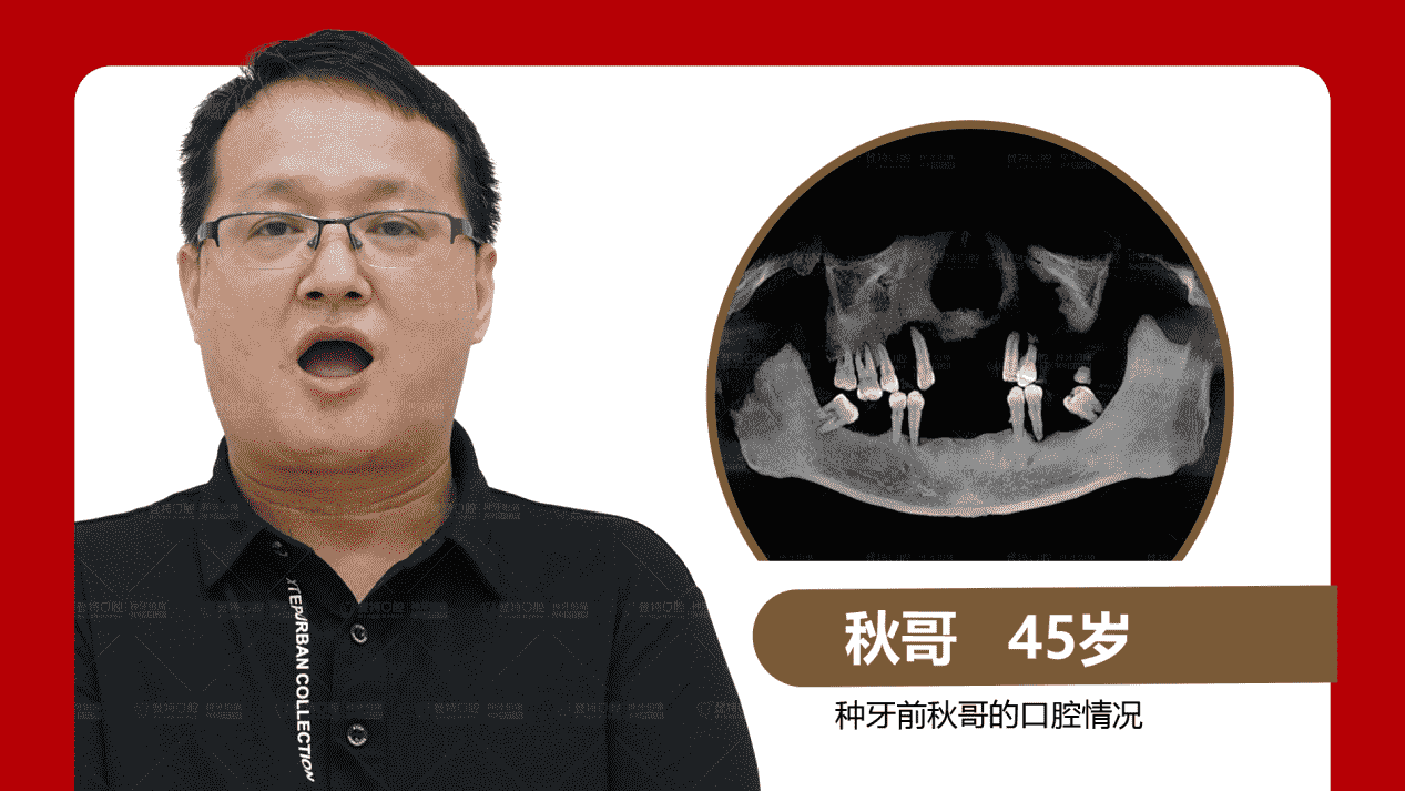 佛山登特口腔：全口半口缺牙修復(fù)方式怎么選？