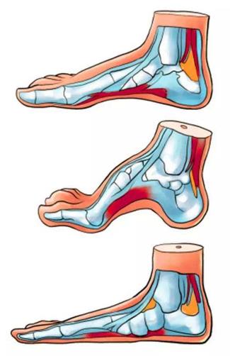 扁平足能跑步嗎？扁平足跑步有什么危害？