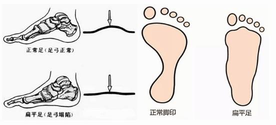 扁平足能跑步嗎？扁平足跑步有什么危害？