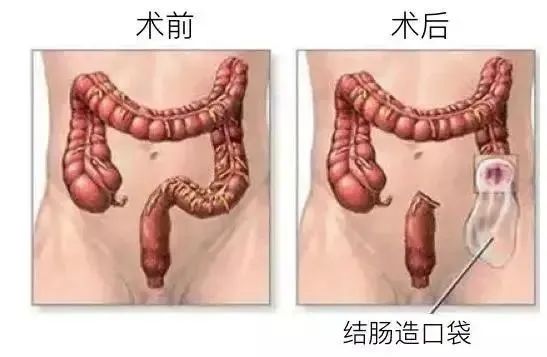 貴陽(yáng)東大肛腸醫(yī)院：30歲小伙每天大便兩三次，確診腸癌！醫(yī)生呼吁：這些人應(yīng)