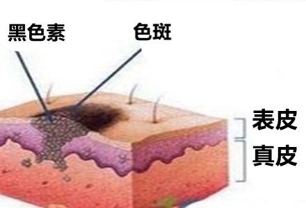 祛斑霜用出終生難愈皮炎，千金散去再也換不回一張計(jì)劃臉！