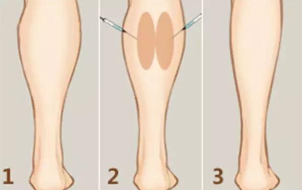 肌肉腿打瘦腿針有用嗎 塑形用時(shí)短便捷不反彈