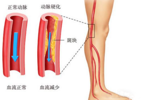 濟(jì)南中醫(yī)靜脈曲張醫(yī)院到底怎么去 謹(jǐn)防收費陷阱