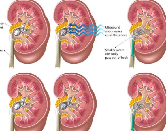 腎結石怎么引起的 排泄功能故障尿酸多草酸沉淀多