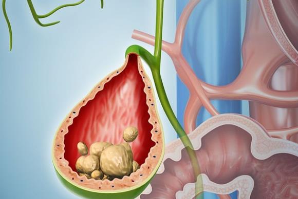 膽結(jié)石怎么形成的 膽汁成分失調(diào)淤積膽囊病變