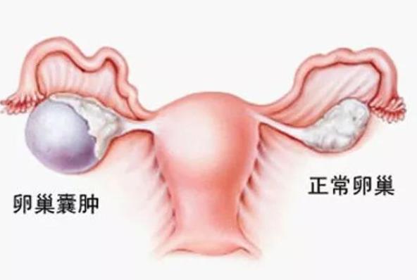 巧克力囊腫能懷上孩子嗎 不孕率高達50％及時治療