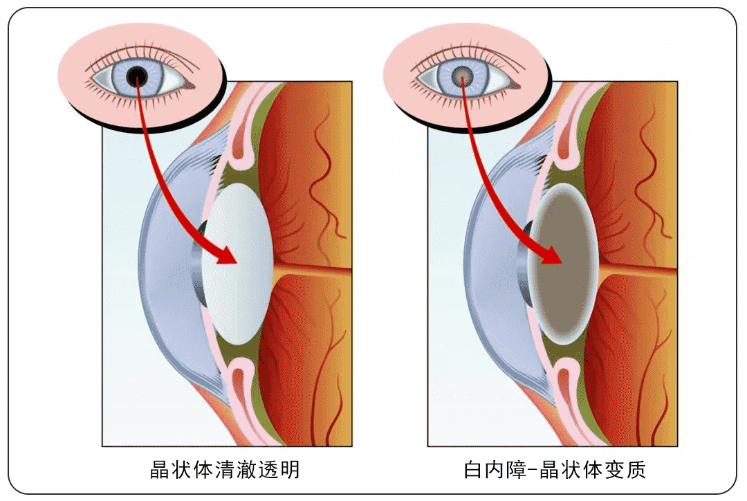 重慶高溫天氣下，普瑞眼科內(nèi)購(gòu)會(huì)護(hù)眼福利來襲