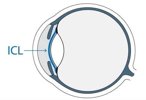 劉保松博士談ICL晶體植入?：同樣是近視手術，ICL為什么那么貴？