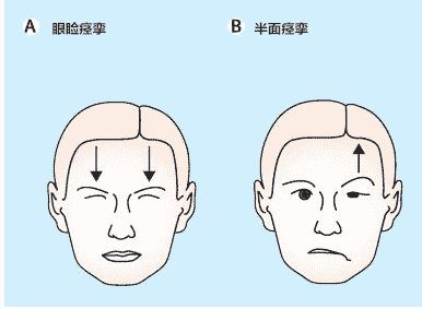 長安面神經(jīng)醫(yī)院居劍峰：口眼聯(lián)動(dòng)是面肌痙攣嗎