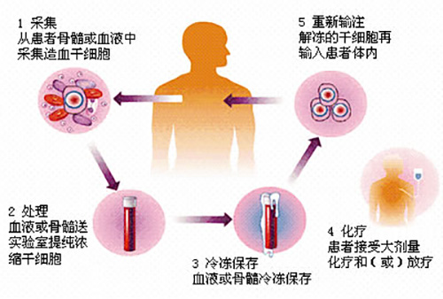 濟(jì)南血液病科普：淋巴瘤患者治療新方法-自體造血干細(xì)胞移植