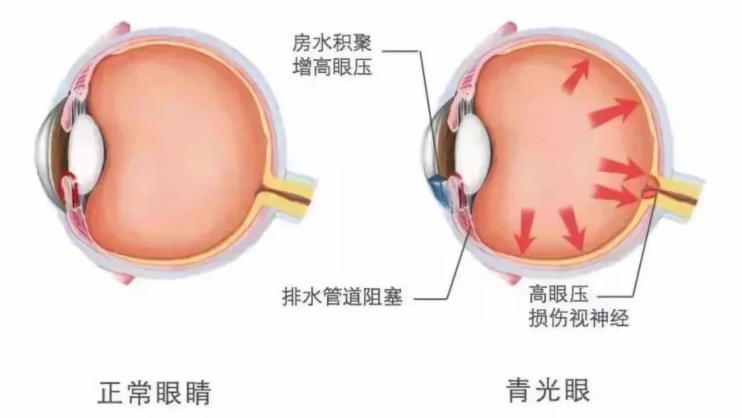 慎防青光眼——合肥愛(ài)爾眼科