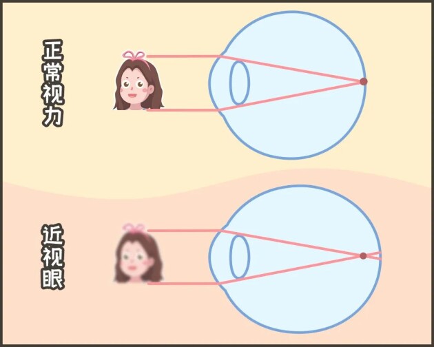 合肥愛爾：「我可以治好你的近視，但不改變度數(shù)。」啥？