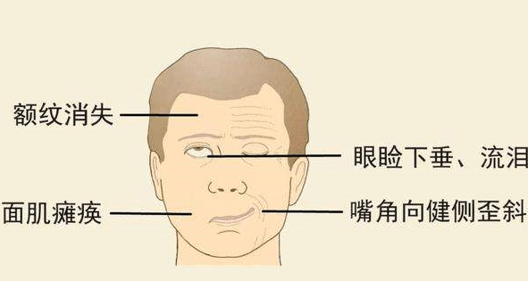 北京廣濟醫(yī)院怎么樣，治療面癱找對科室少走彎路