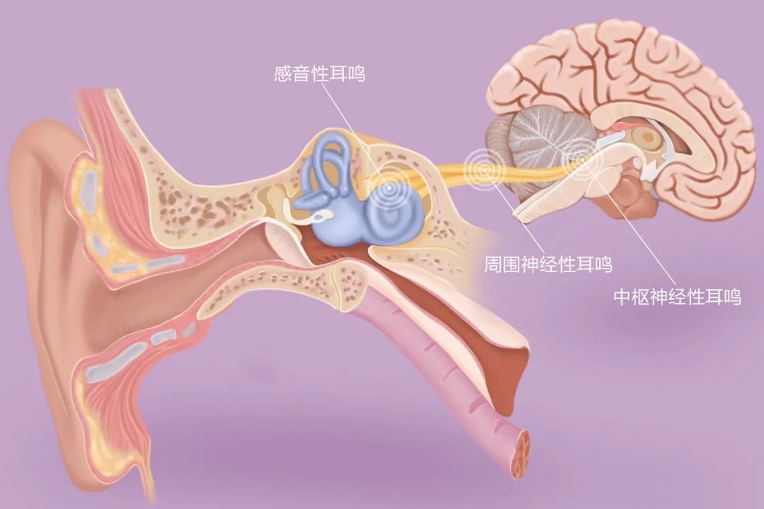 “嚶嚶嚶…”，成都民生耳鼻喉醫(yī)院提醒：耳鳴是身體的警報，須重視！