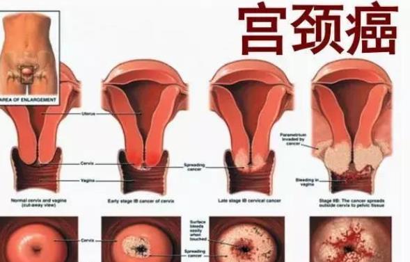 如何預(yù)防宮頸癌 宮頸癌的癥狀是什么