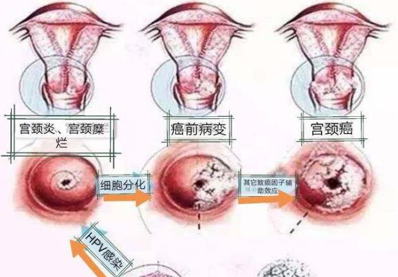 宮頸癌的檢查怎么做 刮片細(xì)胞學(xué)檢查活組織等