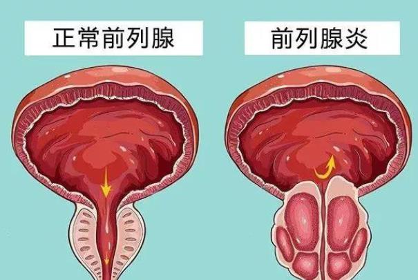 如何預(yù)防前列腺增生 前列腺疾病患者應(yīng)該多喝水嗎