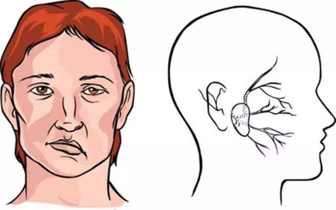 上海健橋醫(yī)院好不好，面癱的兩種常見癥狀和治療方法