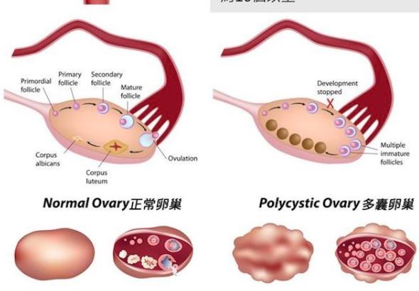 多囊卵巢綜合征病因是什么 肥胖高胰島素血癥藥物遺傳