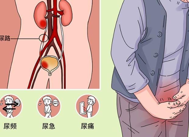 尿路感染有哪些癥狀 尿路感染病原菌是什么