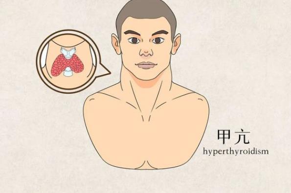 甲亢會(huì)遺傳給孩子嗎 甲亢的遺傳概率有多高