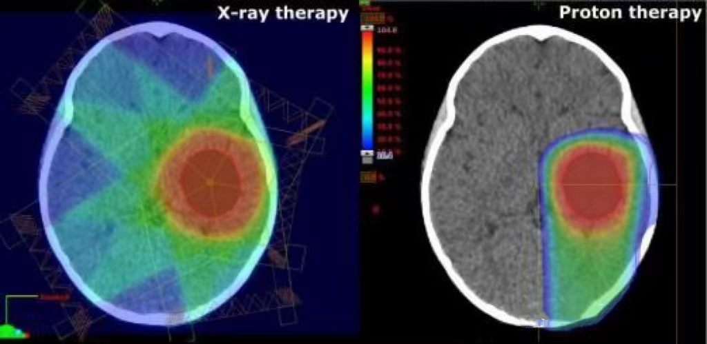 直播科普|質(zhì)子治療為什么是兒童腫瘤放療的“金標(biāo)準(zhǔn)”
