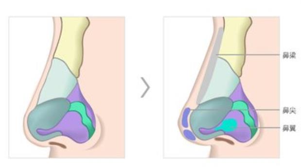 隆鼻取出假體后鼻子會變形嗎 什么情況下需要取出假體