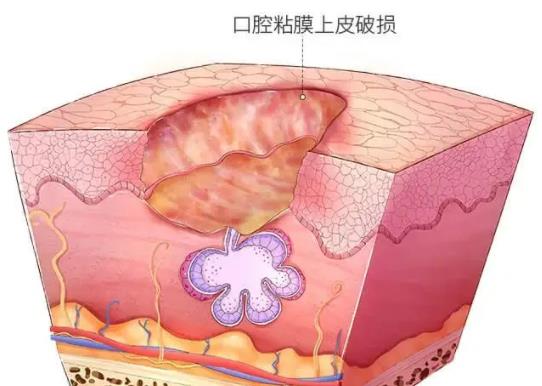 怎么治療口腔潰瘍有效 如何預(yù)防口腔潰瘍