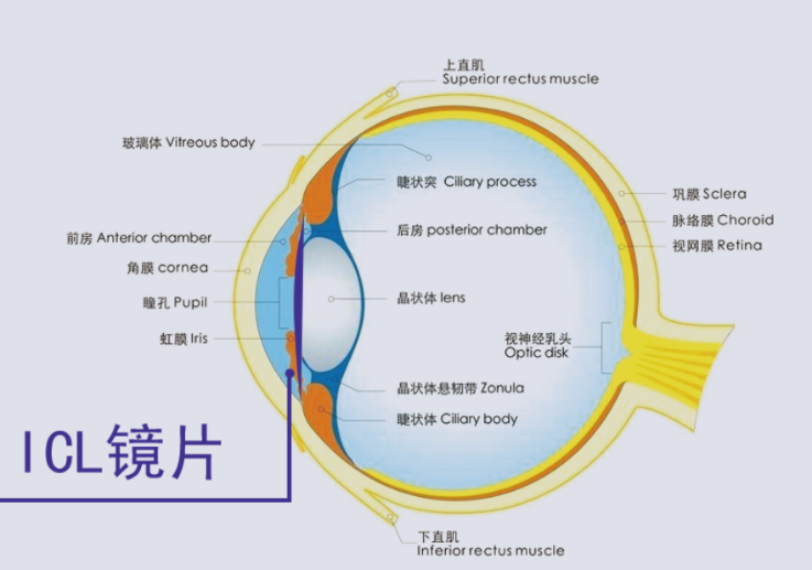  ICL晶體植入術(shù)貴在哪里？合肥普瑞眼科專家來解答（近視手術(shù)鉅惠來襲）