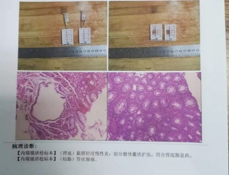 廣州東大肛腸醫(yī)院好不好34歲女士腸息肉切除后3年不查，拖出腸癌