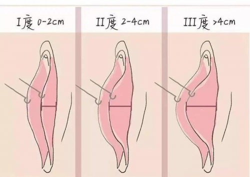 陰唇肥大又看不見，手術(shù)還有必要做嗎？在昆明這里告訴你!