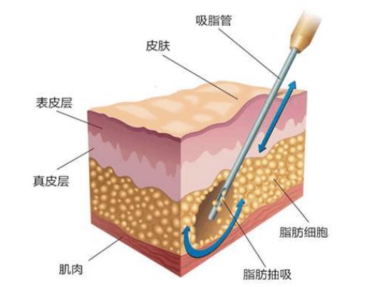 吸脂肪對身體有害嗎 吸脂肪手術需要多少錢