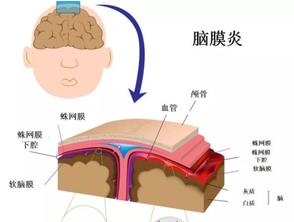 腦膜炎是怎么引起的 各種化膿性細(xì)菌感染