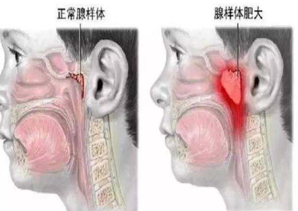 腺樣體肥大一定要做手術(shù)嗎 看臨床表現(xiàn)及藥物治療反應(yīng)