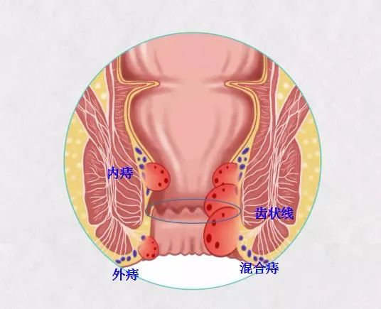 痔瘡之痛何以解，揚州妙手肛腸醫(yī)院為痔瘡病友解決“難言之苦”