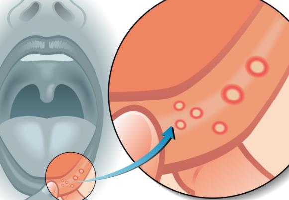 口腔潰瘍怎么快速好 帶牙套口腔潰瘍怎么辦