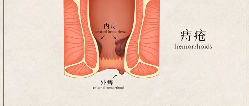 【北京豐益肛腸醫(yī)院】導(dǎo)致炎性外痔的主要原因有哪些？