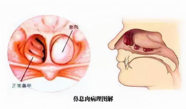 鼻息肉危害有哪些 鼻息肉如何預(yù)防