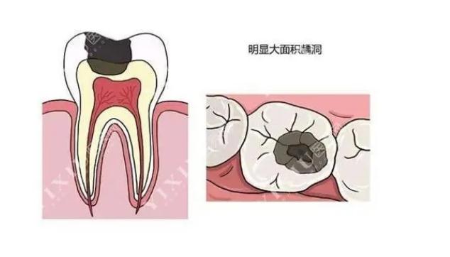 牙齒有洞不補會怎樣？牙齒有洞為什么一定要補？