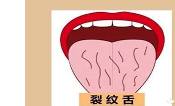 舌頭有裂紋是怎么回事？舌頭有裂紋要治療嗎？