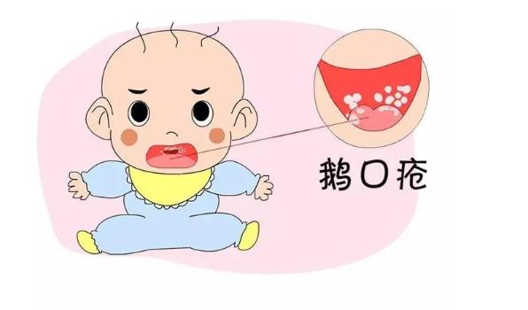 鵝口瘡是怎么引起的？寶寶得鵝口瘡怎么護(hù)理？