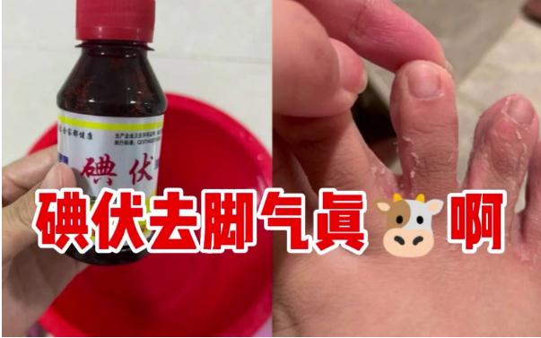 碘伏能治療腳氣嗎？腳氣是缺乏維生素嗎？