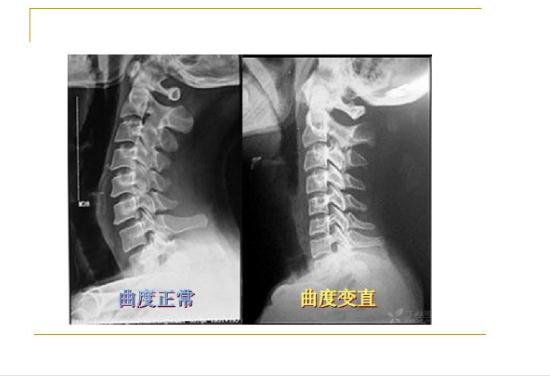 頸椎病能引起后背疼嗎？頸椎病的鑒別診斷有哪些？