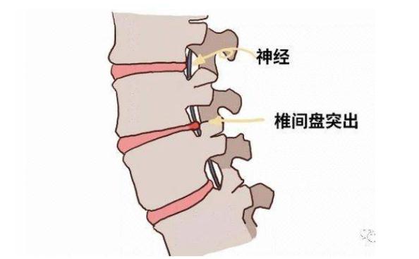 腰間盤突出吃什么藥？腰間盤突出能治愈嗎？