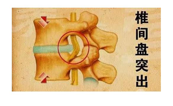 患腰間盤(pán)突出吃什么好？腰間盤(pán)突出怎么鍛煉？