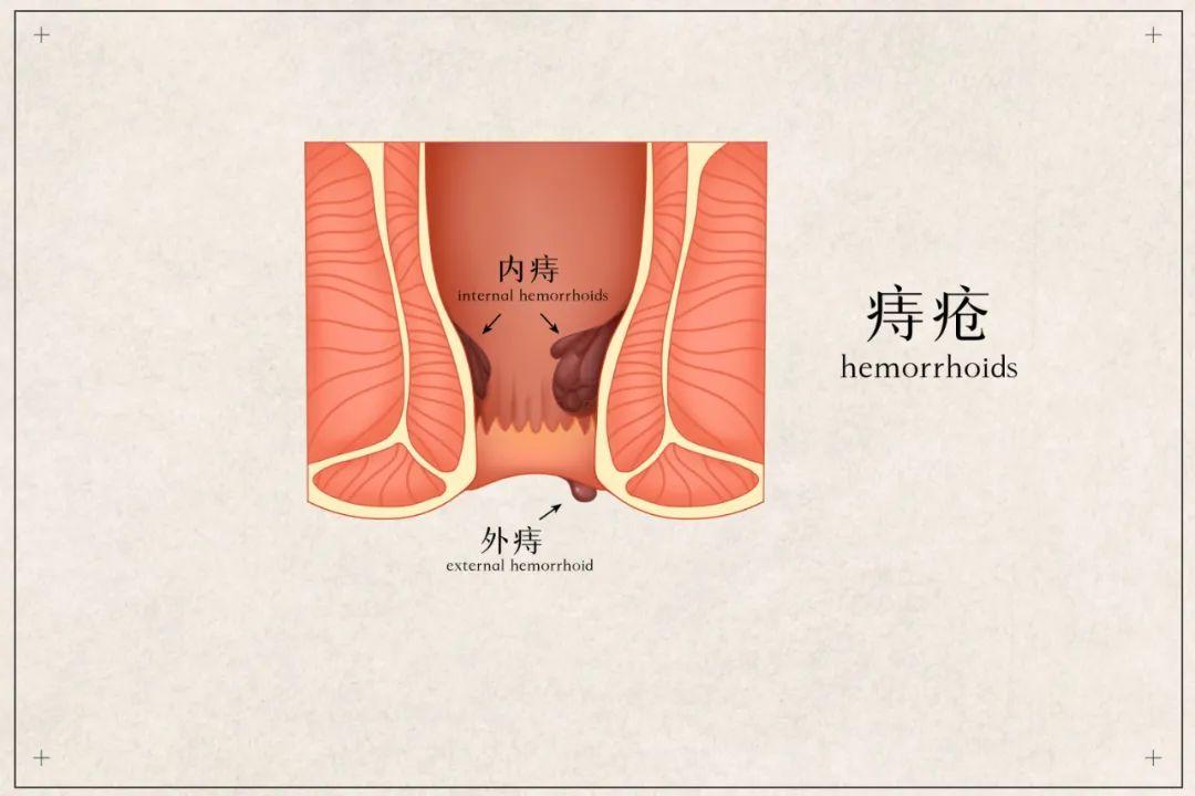 包頭東大肛腸?？漆t(yī)院詳解痔瘡與肛裂如何區(qū)分