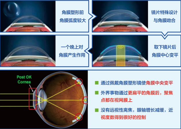 合肥愛爾眼科：角膜塑形鏡只要戴上就行？你想簡單了！